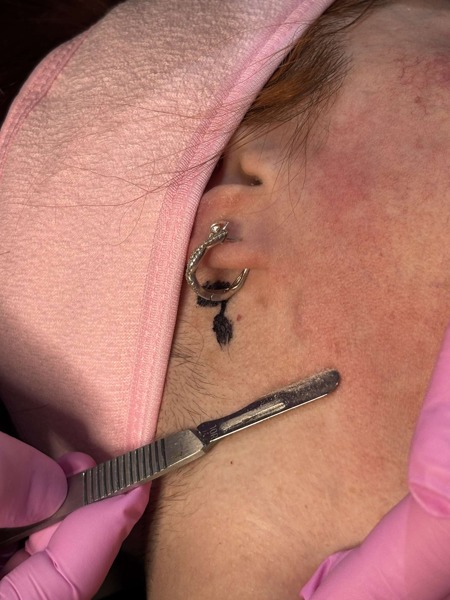 Dermaplaning+