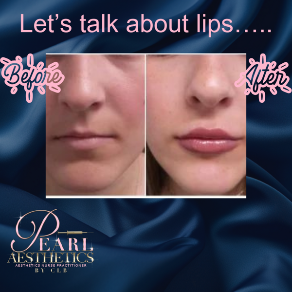 Lip+Augmentation+1ml
